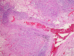 Casi un 30% de las cepas de tuberculosis multirresistente se transmite entre pacientes
