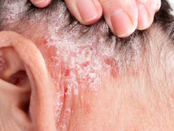 Dermatólogos aseguran que la psoriasis en el cuero cabelludo puede afectar a entre un 60% y un 80% de los pacientes