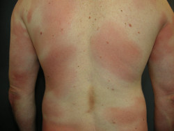 Dermatólogos destacan su "papel fundamental" en el "reto" del diagnóstico temprano de los linfomas cutáneos