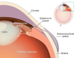 Desarrollan un `microstent` con una forma única para combatir el glaucoma