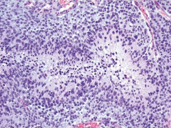 Desarrollan un tratamiento de inmunoterapia prometedor para el tratamiento del c&aacute;ncer cerebral mortal