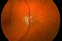 Desarrollan una nueva prueba del glaucoma 15 veces m&aacute;s efectiva en detectar a los pacientes de alto riesgo