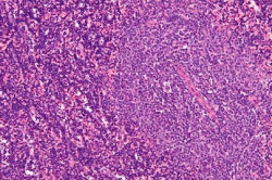 Descubren un gen causante de la leucemia linfoc&iacute;tica cr&oacute;nica, presente en m&aacute;s del 80% de los pacientes