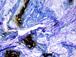 Dos fármacos anticancerígenos combinados demuestran ser eficaces contra el cáncer de pancreas
