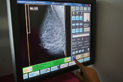 El cáncer de mama no es una única enfermedad, sino que son entidades clínico-patológicas muy variadas, según un experto