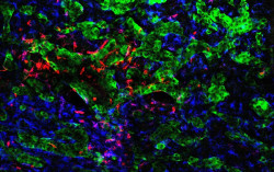 El CNIO identifica c&oacute;mo las c&eacute;lulas tumorales reprograman el cerebro para favorecer la met&aacute;stasis