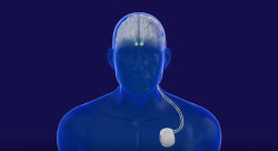 El Marañón, pionero en tratar el Parkinson con un sistema de estimulación cerebral profunda similar a un marcapasos