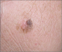 El retraso del diagnóstico de cáncer de piel en el confinamiento supuso más de 100.000 años de vida perdidos en Europa