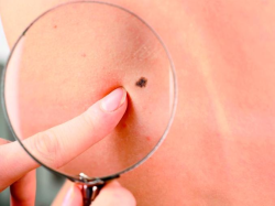 El riesgo de c&aacute;ncer de piel mortal puede medirse por el da&ntilde;o acumulado en el ADN