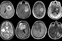 Ensayan un nuevo `f&aacute;rmaco` experimental que mata las c&eacute;lulas tumorales en humanos con glioblastoma