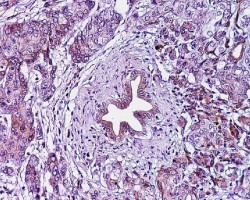 Expertos reclaman la inversi&oacute;n necesaria para reducir las tasas de mortalidad por c&aacute;ncer de p&aacute;ncreas en Europa