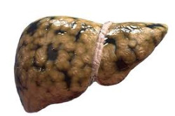 Hallan una posible nueva estrategia de tratamiento para la enfermedad del h&iacute;gado graso