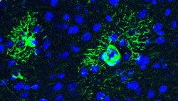 Investigadores españoles descubren un mecanismo que puede ayudar a detectar el Alzheimer en fases tempranas