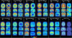 Investigan Detecci&oacute;n precoz del Alzheimer mediante la medici&oacute;n de la glucosa en el cerebro por resonancia magn&eacute;tica