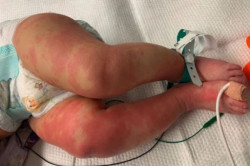 La OMS estudia el posible v&iacute;nculo de la rara enfermedad de Kawasaki en ni&ntilde;os peque&ntilde;os con el Covid-19