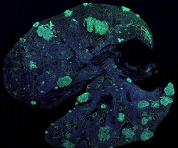 Los ARN reguladores promueven la met&aacute;stasis del c&aacute;ncer de mama