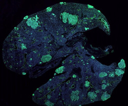 Los investigadores identifican c&oacute;mo prevenir las met&aacute;stasis del c&aacute;ncer