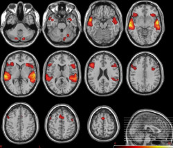 Los s&iacute;ntomas de psicosis, vinculados a la deficiente difusi&oacute;n de informaci&oacute;n en el cerebro que contribuye a los delirios
