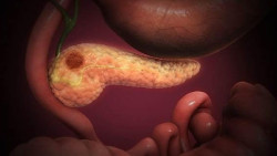 No se ha conseguido avanzar en el diagnóstico precoz del cáncer de páncreas, indica un experto
