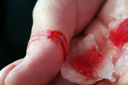 Observan por primera vez el papel de los fibroblastos en el proceso de cicatrizaci&oacute;n de heridas