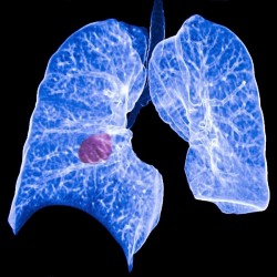 Obtienen nuevos conocimientos sobre la biología de los tumores de pulmón y posibles dianas farmacológicas
