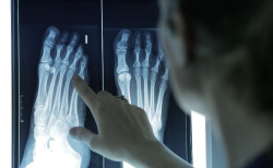 Pod&oacute;logos advierten de que el 60% de los adultos padece deformidades en los dedos de los pies