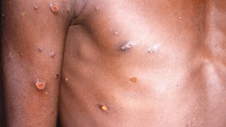 Sanidad notifica 4 nuevos casos de viruela del mono en los últimos 10 días