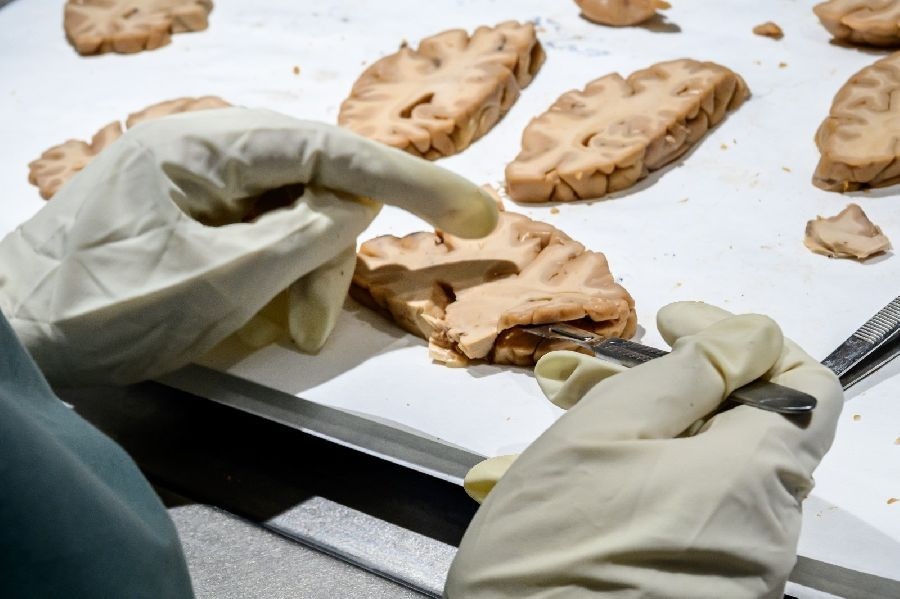 Un an&aacute;lisis de sangre permite estimar el riesgo de Alzheimer en personas sanas hasta una d&eacute;cada antes, seg&uacute;n un estudio