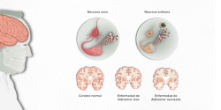 Un estudio apunta que un desencadenante inflamatorio es una nueva pista para el Alzheimer