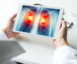 Un estudio del GECP confirma el beneficio de la quimio-inmunoterapia para c&aacute;ncer de pulm&oacute;n y met&aacute;stasis cerebral