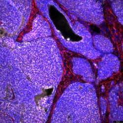 Un estudio descubre un nuevo bloqueador molecular que frena la met&aacute;stasis del c&aacute;ncer de mama