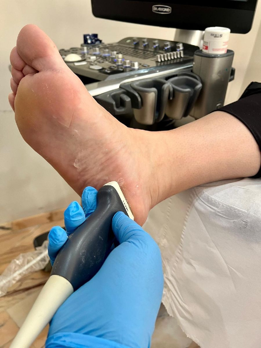 Un estudio refuerza el valor de la ecograf&iacute;a para mejorar el diagn&oacute;stico de la fascitis plantar