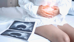 Un estudio vincula el cáncer de ovario con la colonización bacteriana en el microbioma