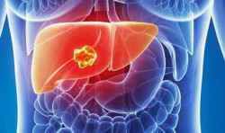 Un l&iacute;quido que elimina el tumor ofrece una terapia m&aacute;s segura para los pacientes con c&aacute;ncer de h&iacute;gado