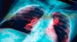 Un nuevo enfoque contra el c&aacute;ncer de pulm&oacute;n consigue una reducci&oacute;n completa del tumor en el 38% de los pacientes