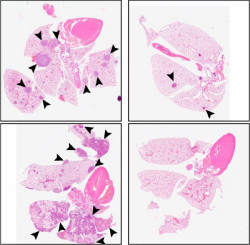 Un tratamiento experimental podr&iacute;a prevenir la met&aacute;stasis `durmiendo` a las c&eacute;lulas cancerosas
