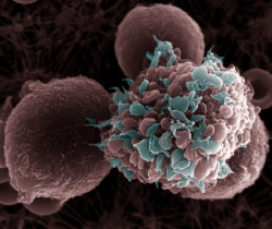 Una dieta alta en grasas aumenta el riesgo de metástasis del cáncer de mama, según un estudio con ratones