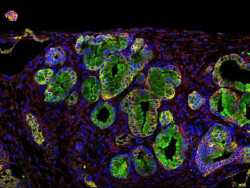 Una proteína antibacteriana, nueva diana terapéutica contra el cáncer de páncreas, según un estudio de CSIC